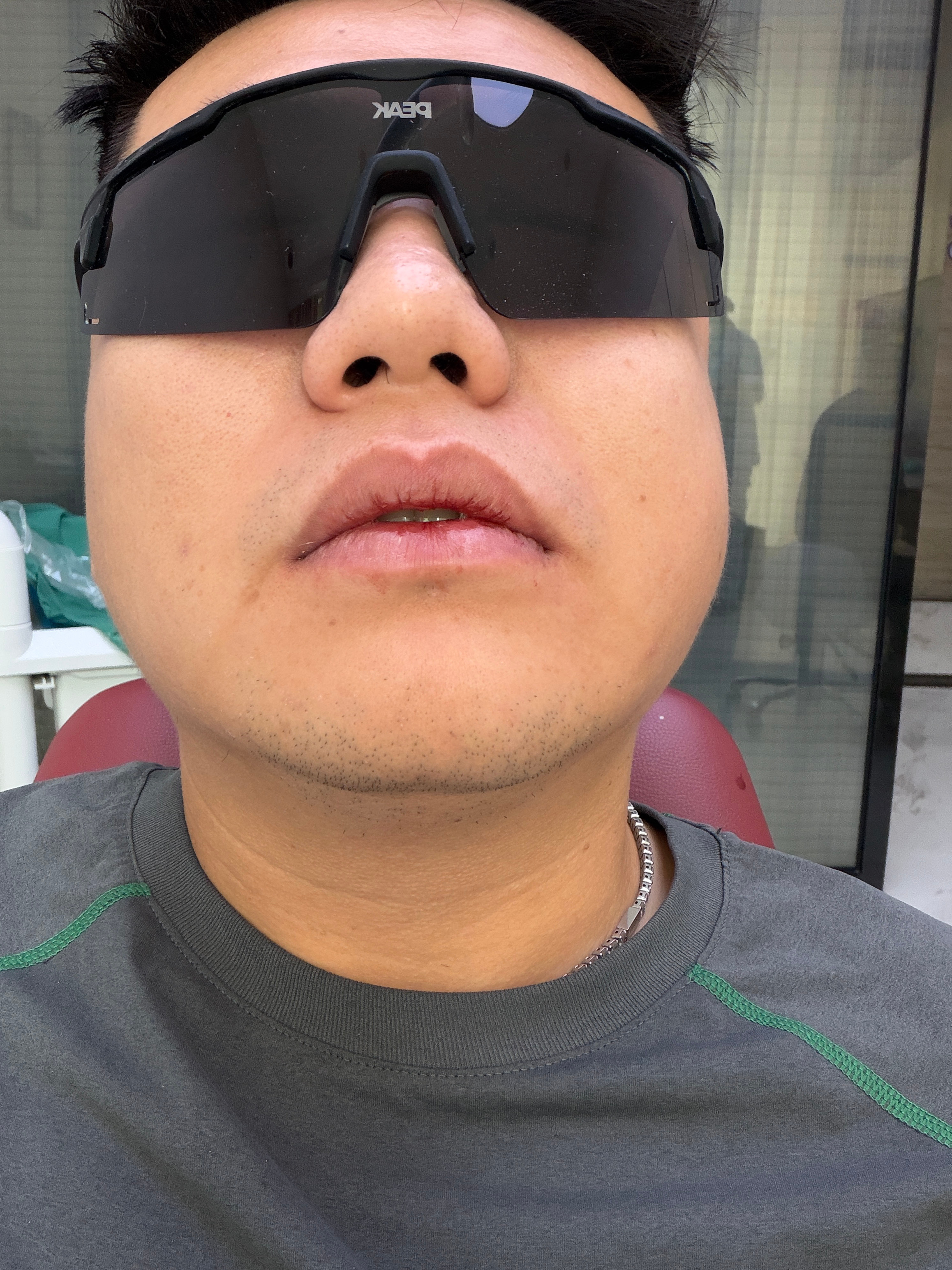 终于把右边上下智齿拔了 我对局麻是真的太耐受忍着难受拔出来 给医生累坏了 本来头