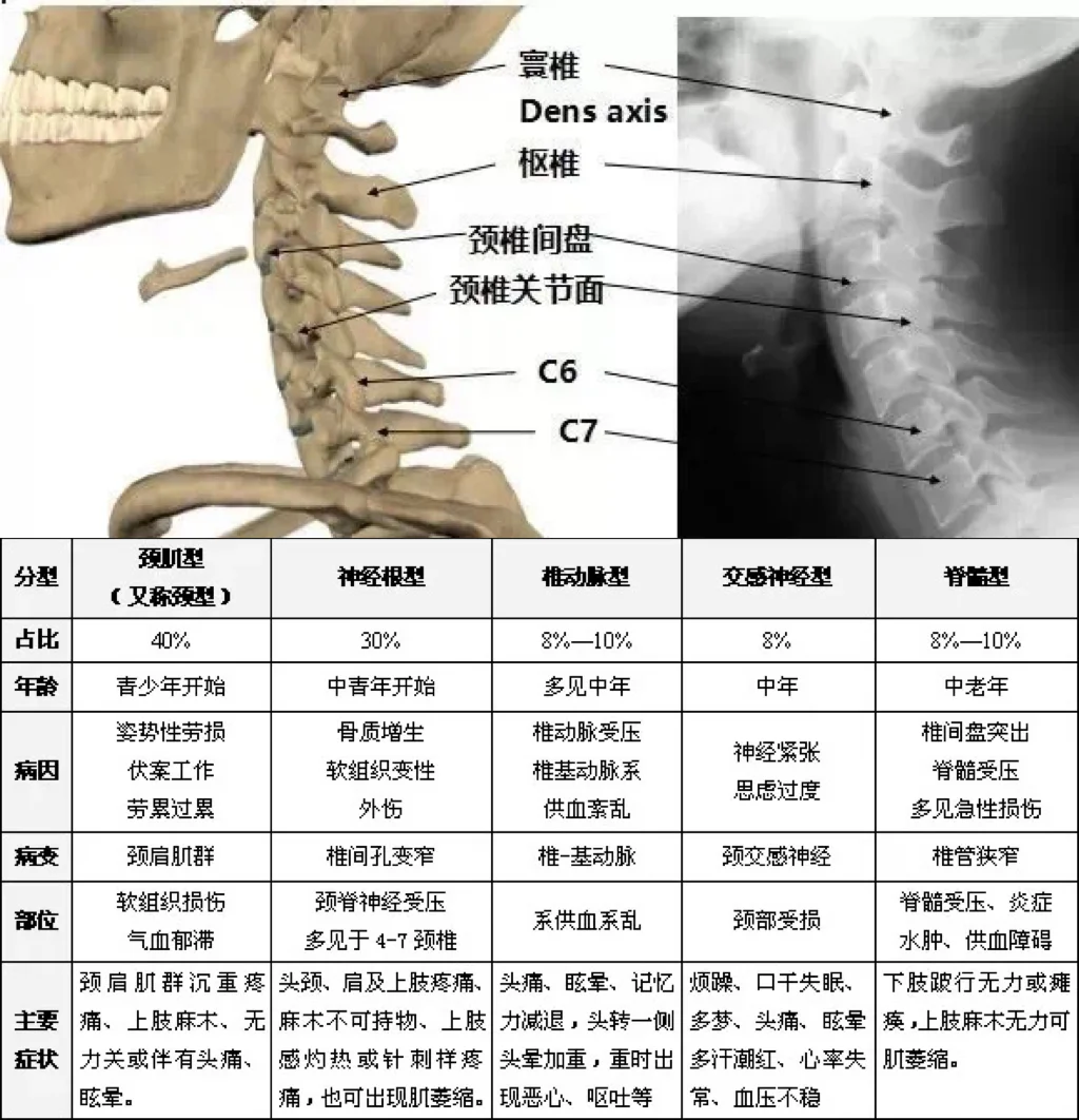 颈椎分型总结