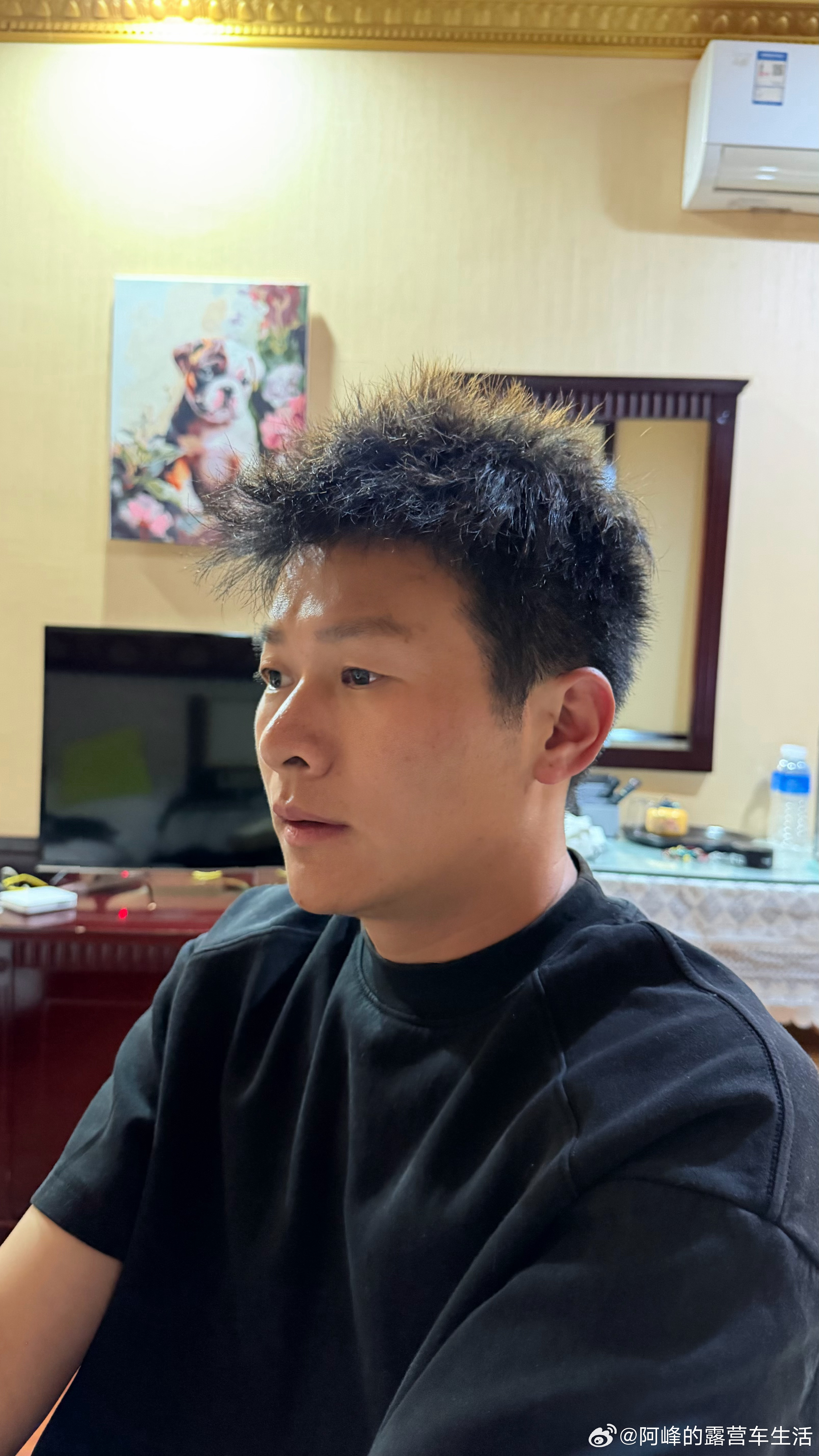 植发9个月了，最大的变化就是我的M角处回到了20岁左右现在吹发型，剪发型都不用特