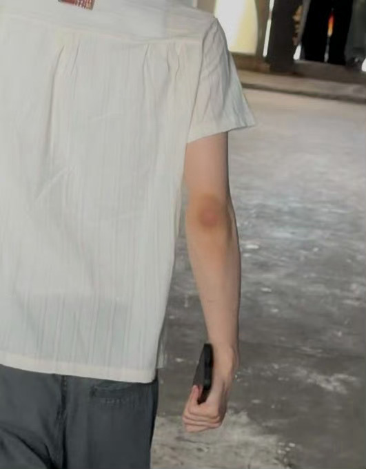 我家脆皮孩儿…..崴脚 胳膊上的疤……胳膊肘子磕到…..腿上两深疤🥹 