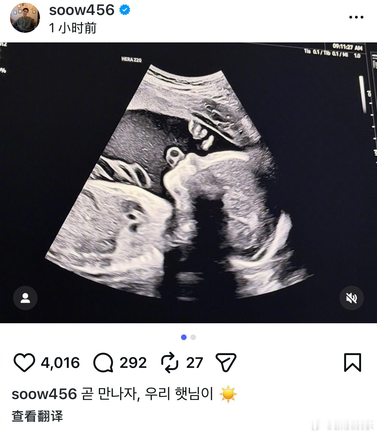 宋承炫宣布当爸宋承炫老婆怀孕 21日，前FTISLAND成员宋承炫晒宝宝B超照，