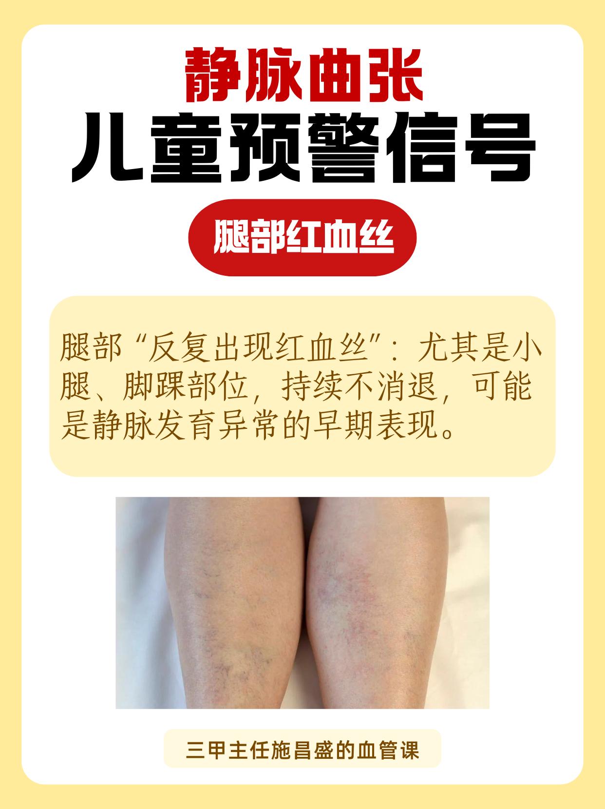 静脉曲张儿童预警信号。儿童静脉曲张虽少见，但出现这些信号需关注，早预防早干预。