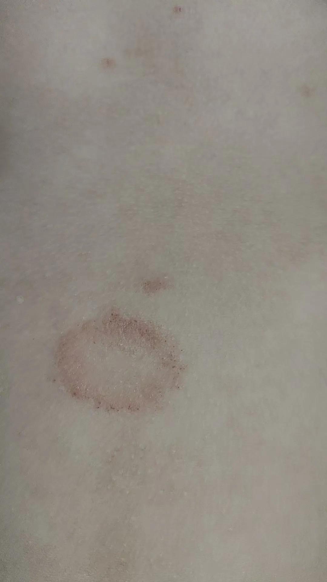 哪位是皮肤科医生，给看看这身上起的是什么？这是一个六岁小女孩，身上起了几个红圈圈