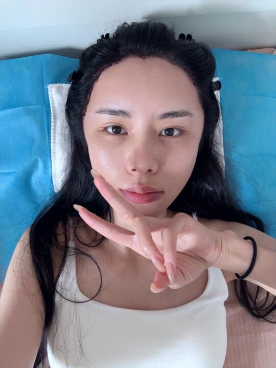 不剃发第二天～肿胀