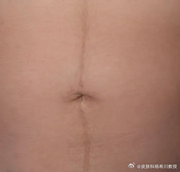 做个小调查，你的肚子中间有这条线吗？有的朋友点个赞。[赞]这是腹中线，是腹直肌鞘