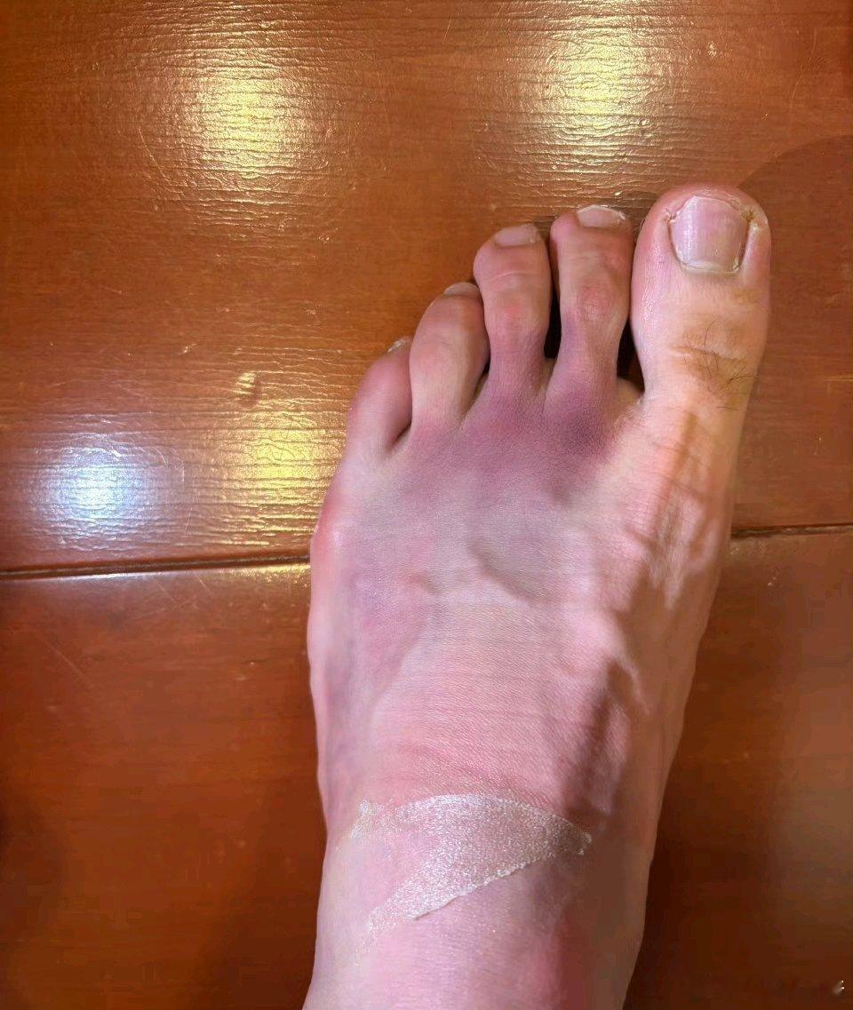 心疼小商[伤心][伤心]商竣程左脚淤血严重 🇨🇳商竣程脚肿成这样。。。之前采
