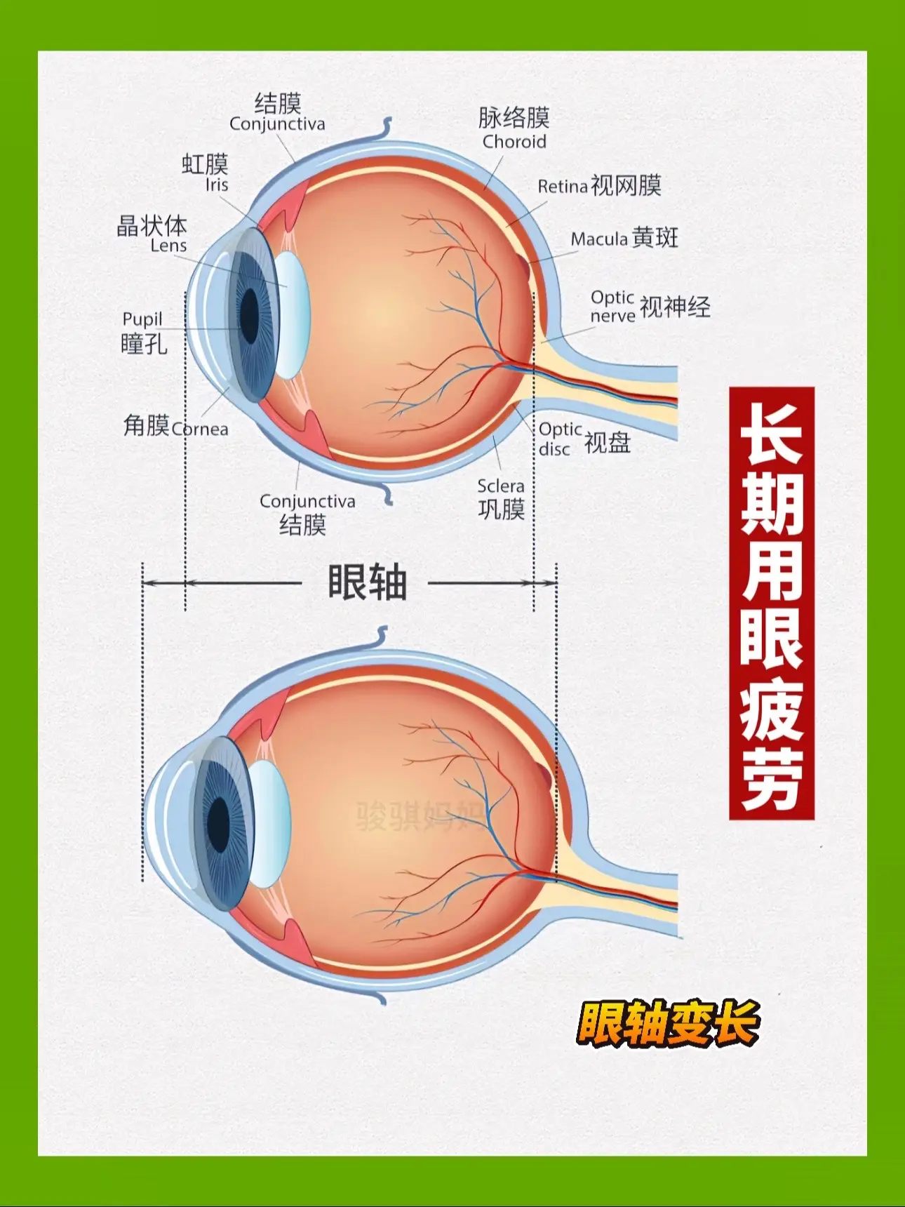 长期用眼疲劳会导致眼轴变长，学习虽然很重要，但眼睛却是一辈子的事情！睡...