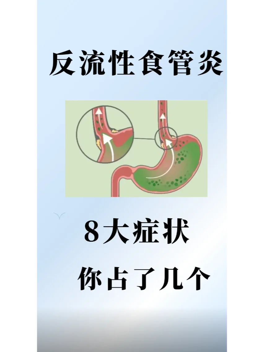 反流性食管炎8大症状，你占了几个？