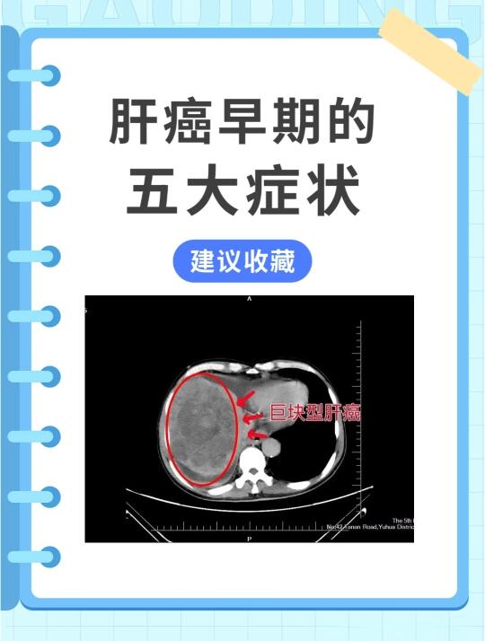 肝癌早期的5大症状，希望没有你！