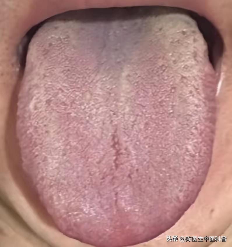 为什么你吃逍遥丸没用？舌上一道深裂纹，告诉你真相：
 
只疏肝、不清火、不祛湿，