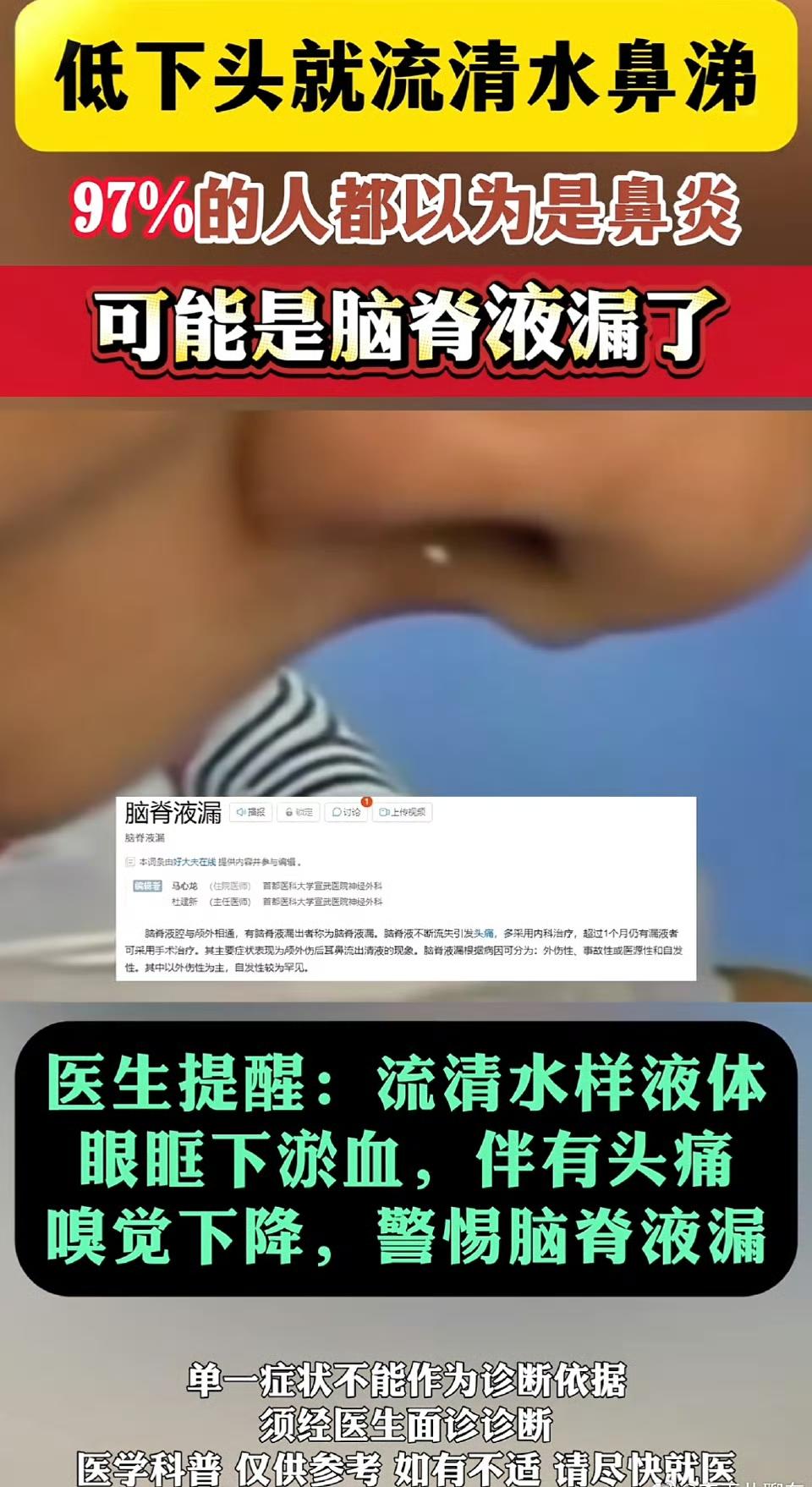 广东39岁的罗女士被“流鼻涕”折磨了20天。一开始她以为是鼻炎，自己买药吃却毫无