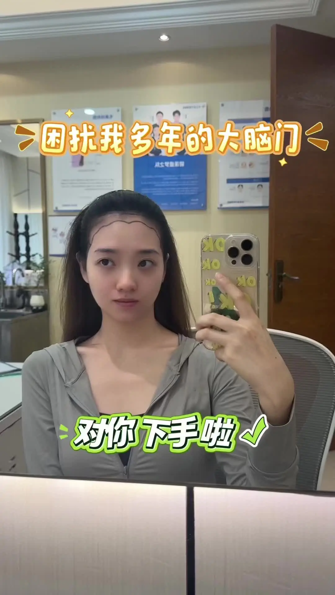 不剃发植发 大脑门886 不剃发植发，太香啦！！！头包脸！高颅顶！轻松拿下！
