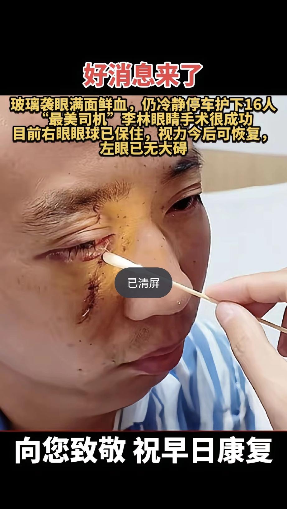 玻璃炸裂刺伤双眼满脸是血，司机李林却强忍剧痛稳稳刹住车，护住了全车16人。这惊人