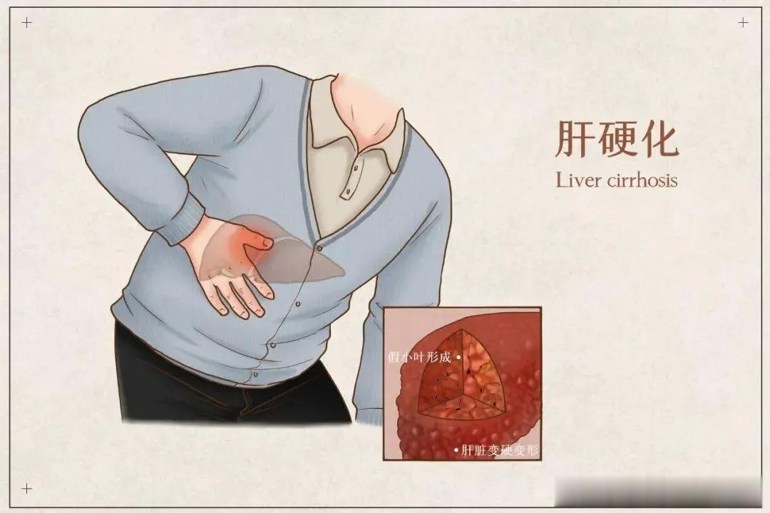 肝硬化的8种常见治疗方法总结，希望可以帮到你1. 抗病毒对于乙肝后肝硬化，坚持抗