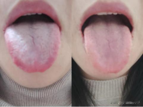 顽固失眠，一周时间让舌象从左到右，调理只需要三步！
第一步：
那就是清理舌苔，舌