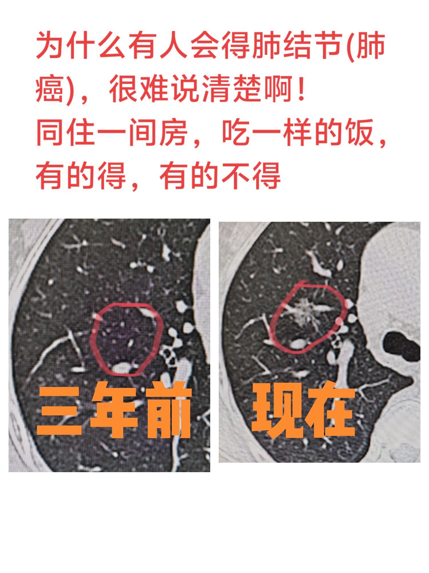 为何有人长肺结节/肺癌，有人没。1. 外在环境 同样的环境，靠近油烟...