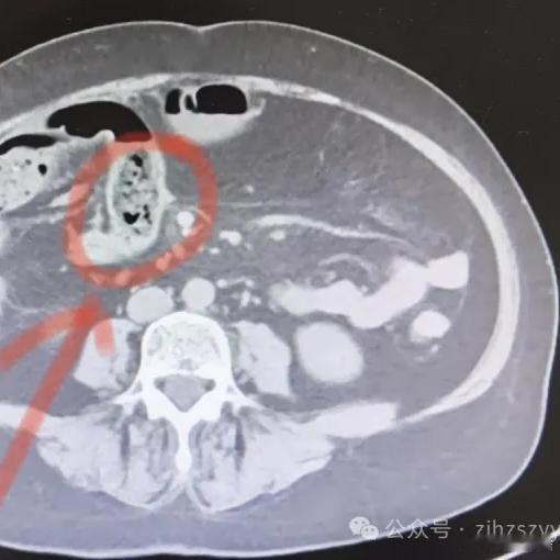 一次吃一个没事儿 吃太多了这是啊......《一口气吃了好几个，女子腹部剧痛！医