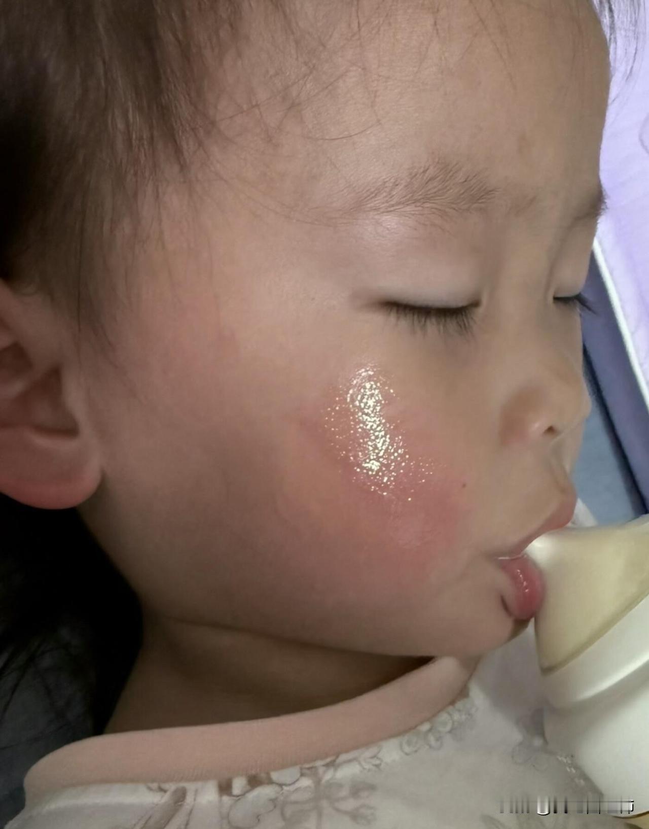 娃脸被仙女棒烫伤了怎么办
爸爸带娃的瞬间，跟我说是划伤了，我凑近看泡都破了，明显