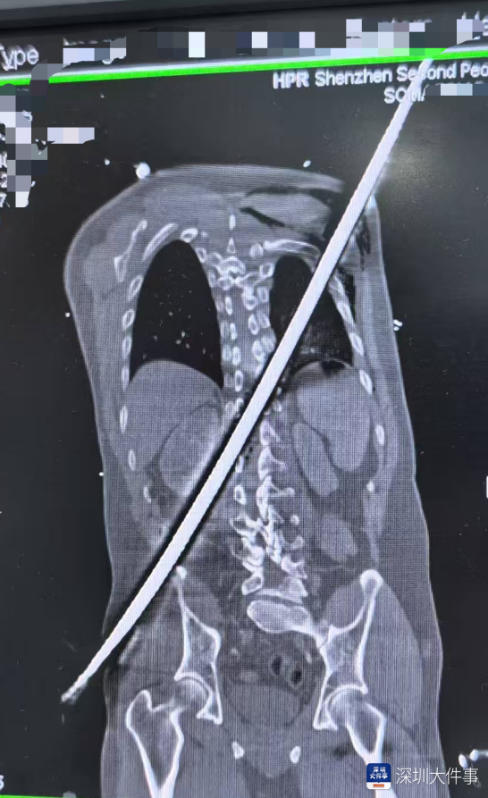 #男子被67厘米钢筋从右臀斜插左肩#【67厘米钢筋穿体，男子命悬一线！深圳医院生