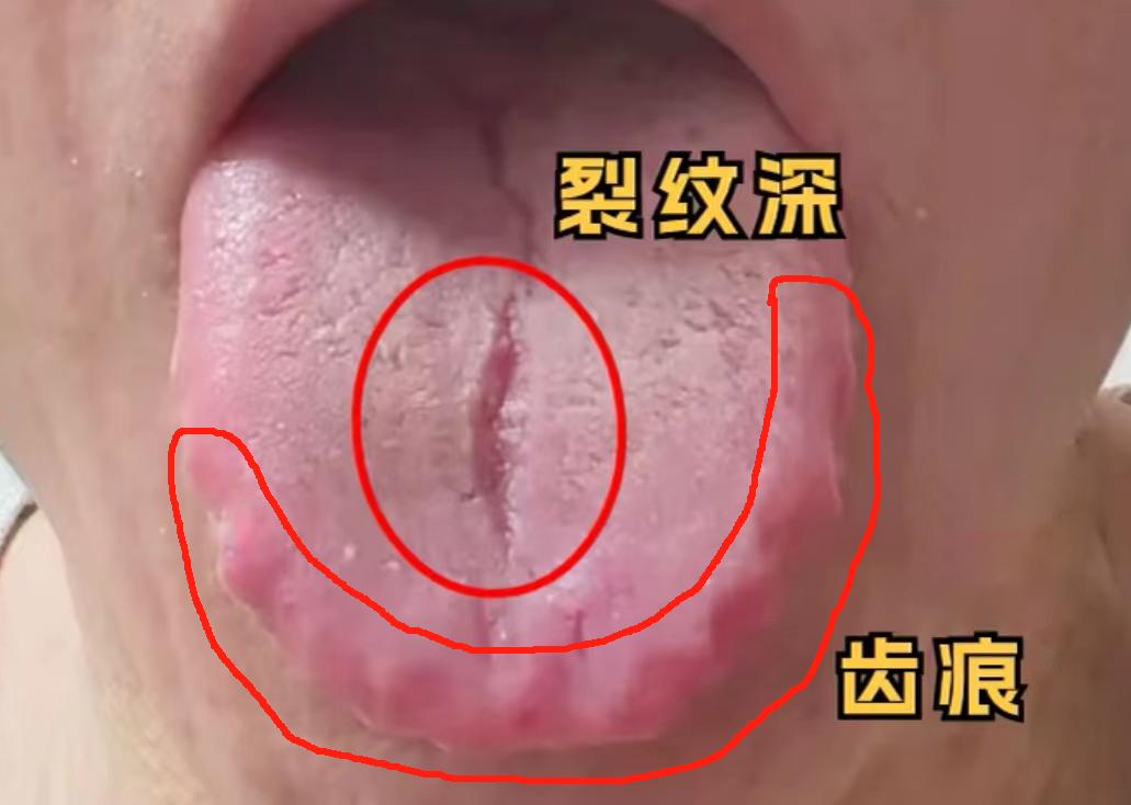 遇见这种齿痕舌，还有裂纹，潘医大夫只想说一句
千万别健脾祛湿了！我真的很担心，你