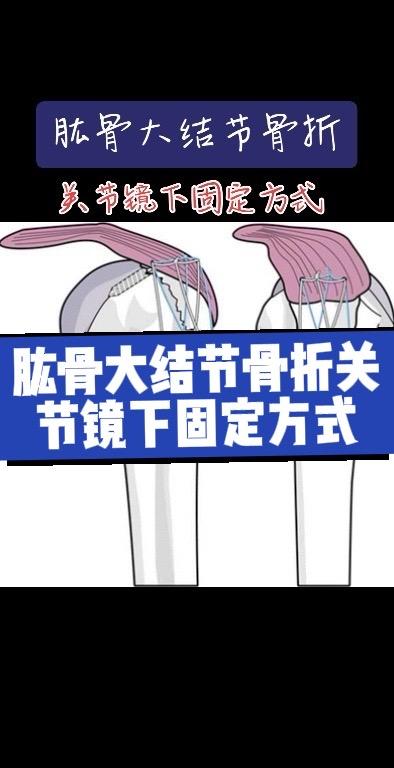肱骨大结节骨折。关节镜下固定技术
