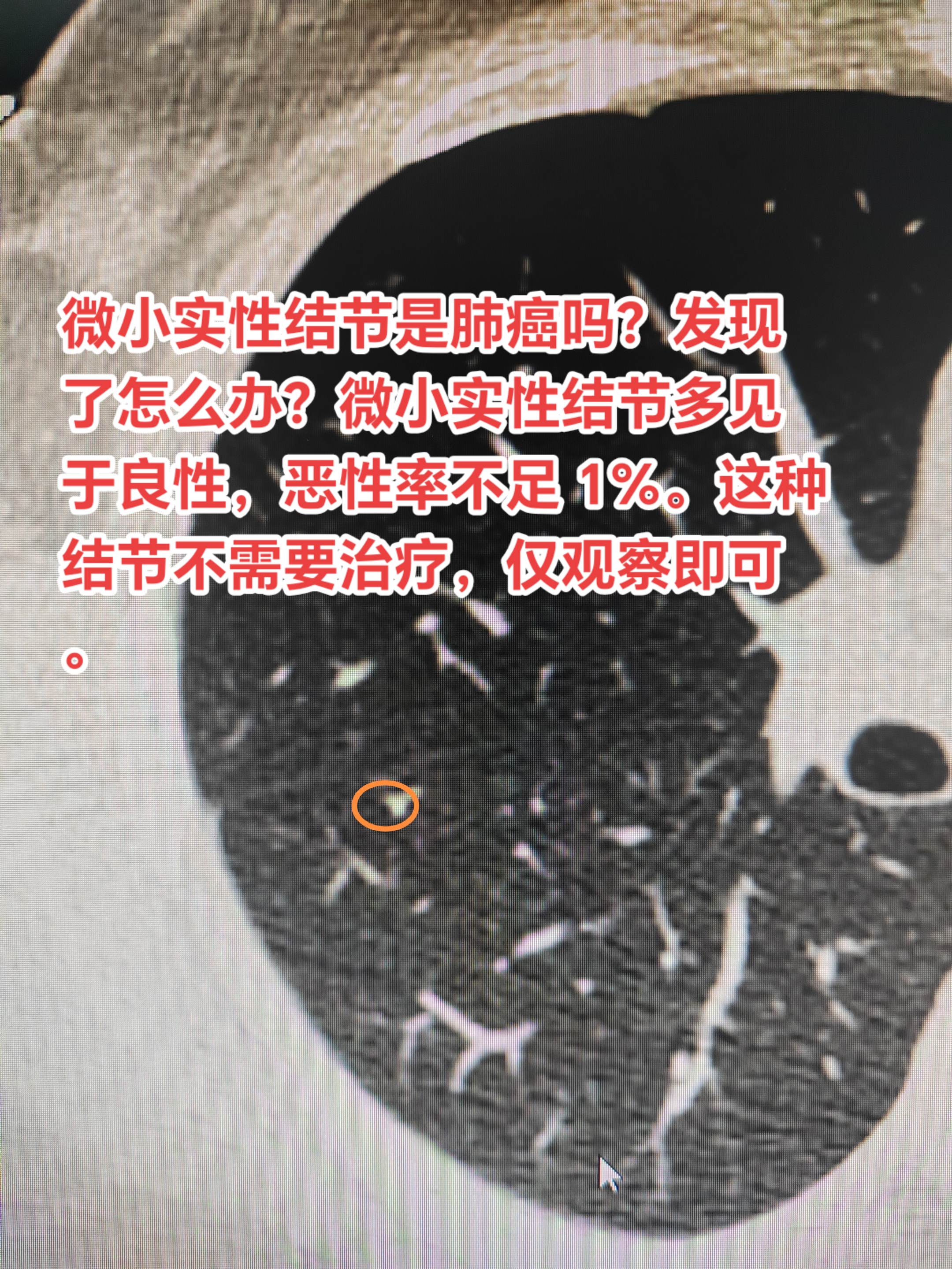 微小实性结节是肺癌吗？发现了怎么办？微小实性结节多见于良性，恶性率不足...