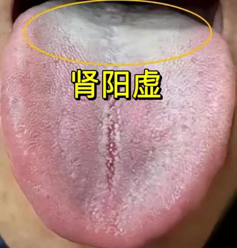 桂附地黄丸对应的肾阳不足证舌象及辨证解析
中医辨证中，舌象是望诊核心，能直观反映