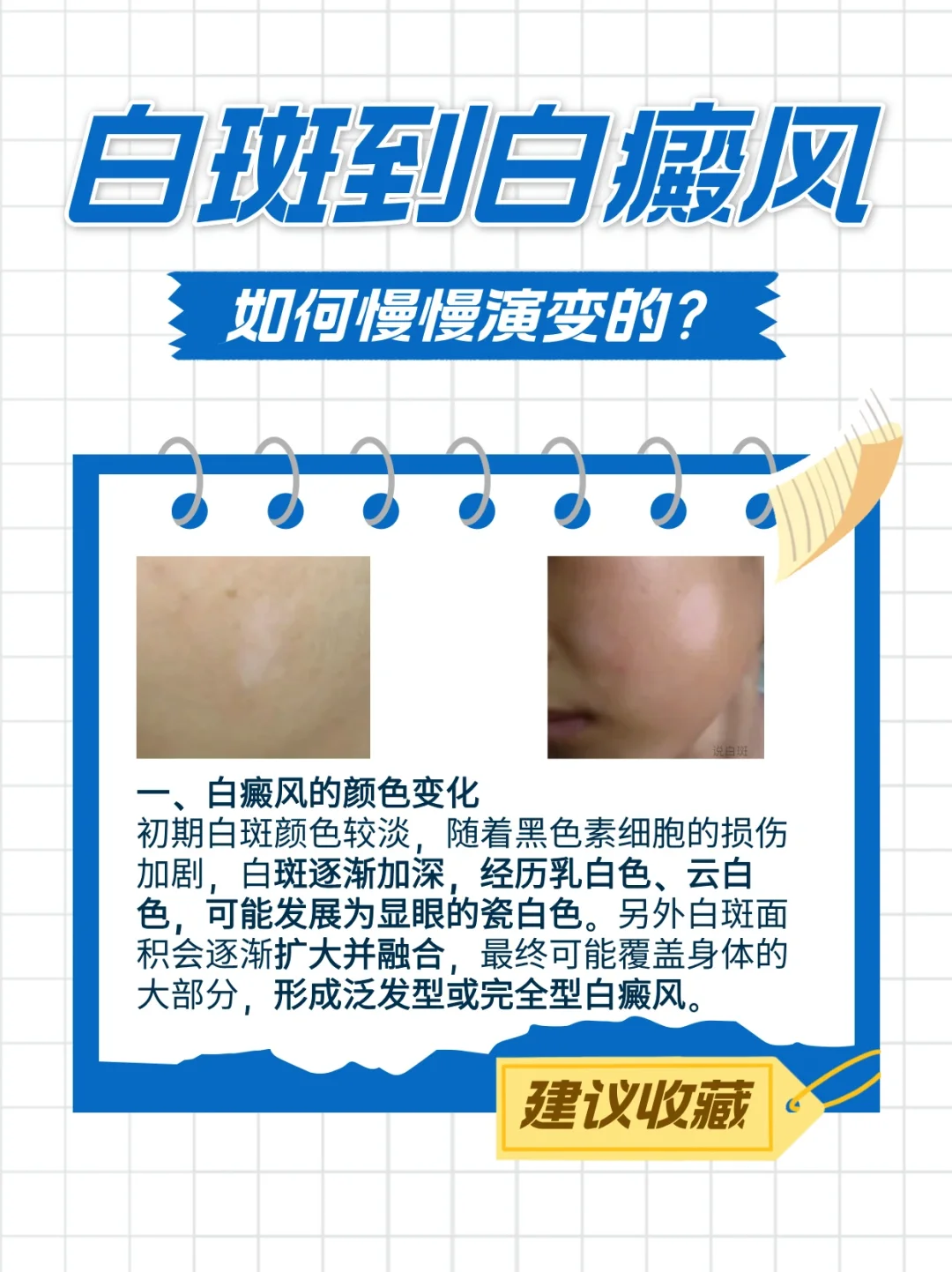 白斑是怎么慢慢演变白癜风❓有白斑要早知道
