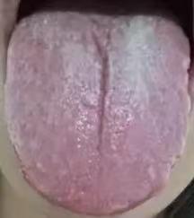 舌下青筋粗？医生却说不能化瘀？根源在它！

像这种舌下青筋较粗的舌象，千万不能直