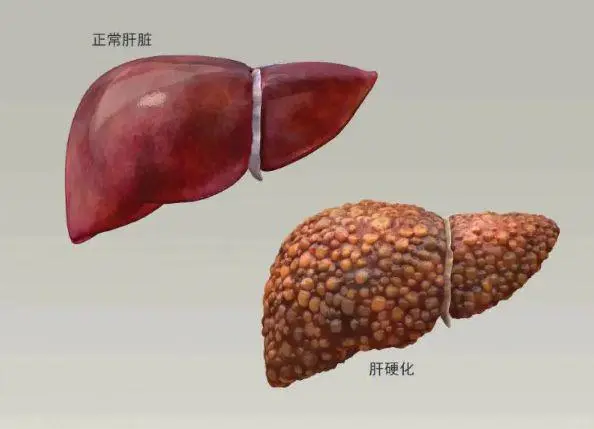 不痛不痒查出肝硬化，查出肝硬化还能活多久？主要取决于以下3点！ 1、发...