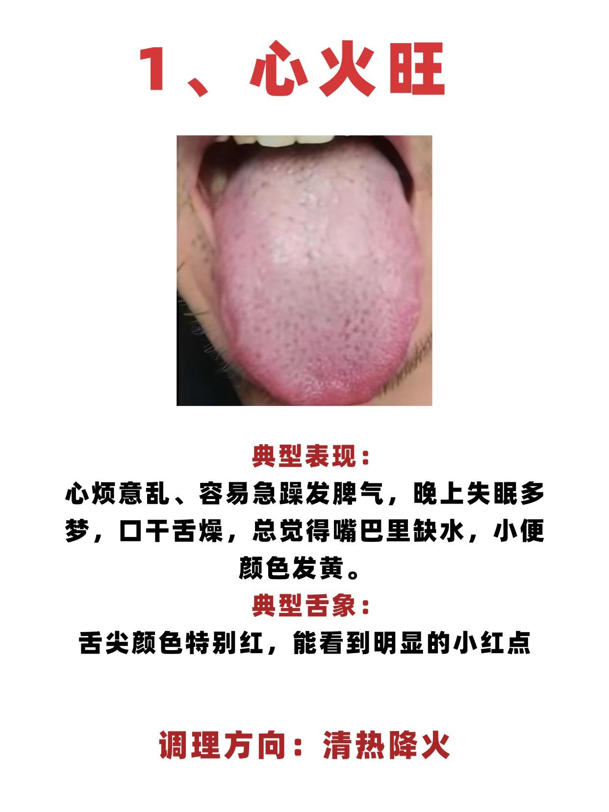 心火旺，肝火旺，胃火旺，身体都有表现呢？