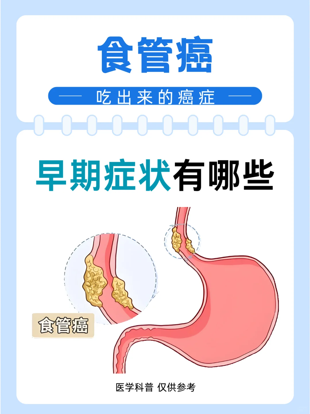 吃出来的癌症，食管癌早期症状有哪些？