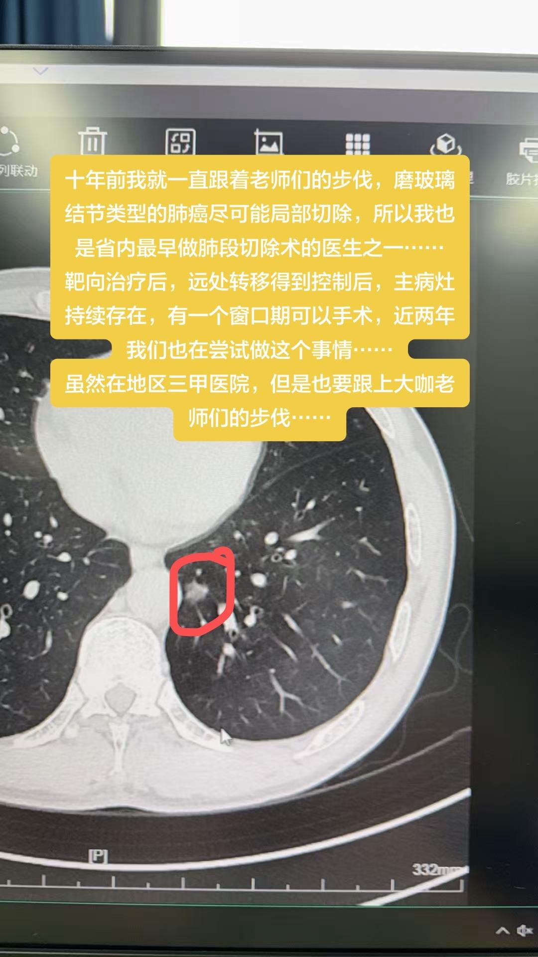 站得高，看得远……十年前我就一直跟着老师们的步伐，磨玻璃结节类型的肺癌...