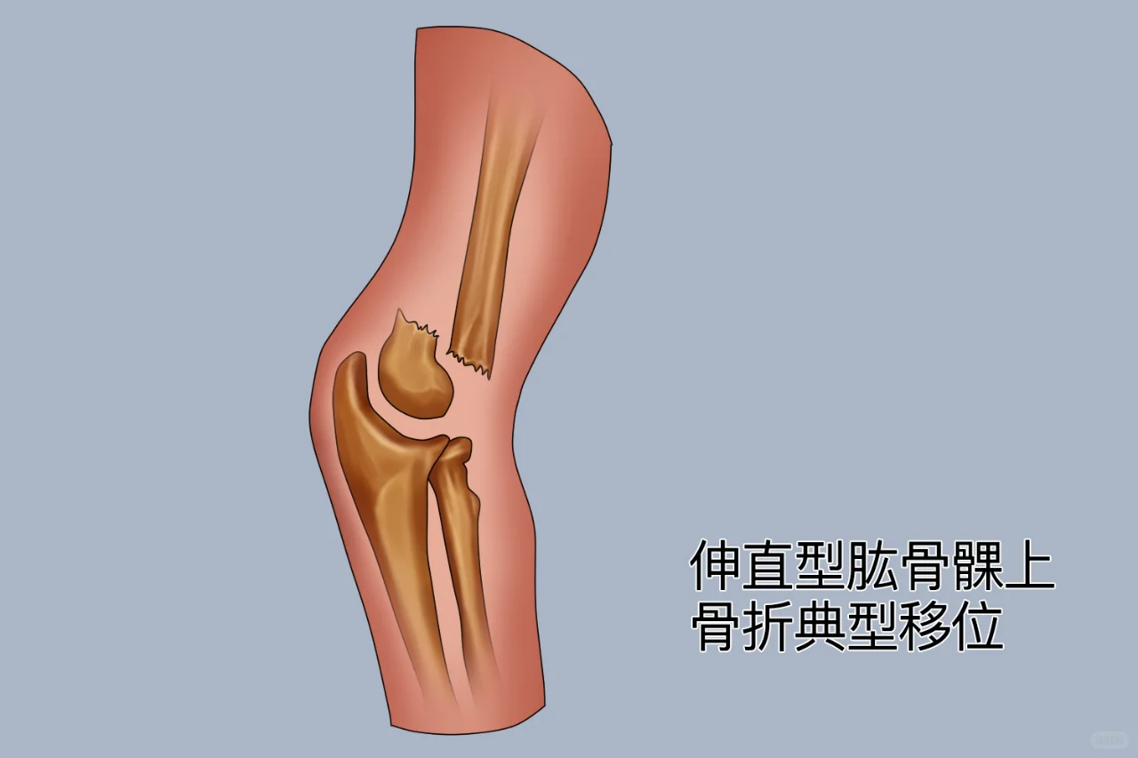 肱骨髁上骨折解剖图