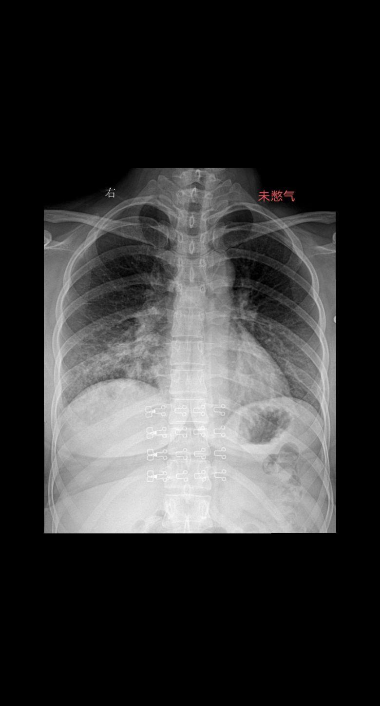家人们你们拍胸片的时候让患者深呼吸憋气吗  患者主诉咳嗽感冒一周29岁女