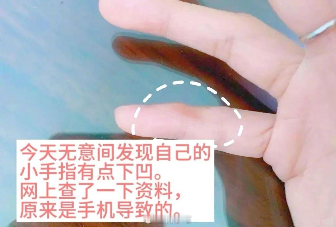用小拇指做手机支架的受害者出现了，手指出现明显凹痕，大家千万要注意 