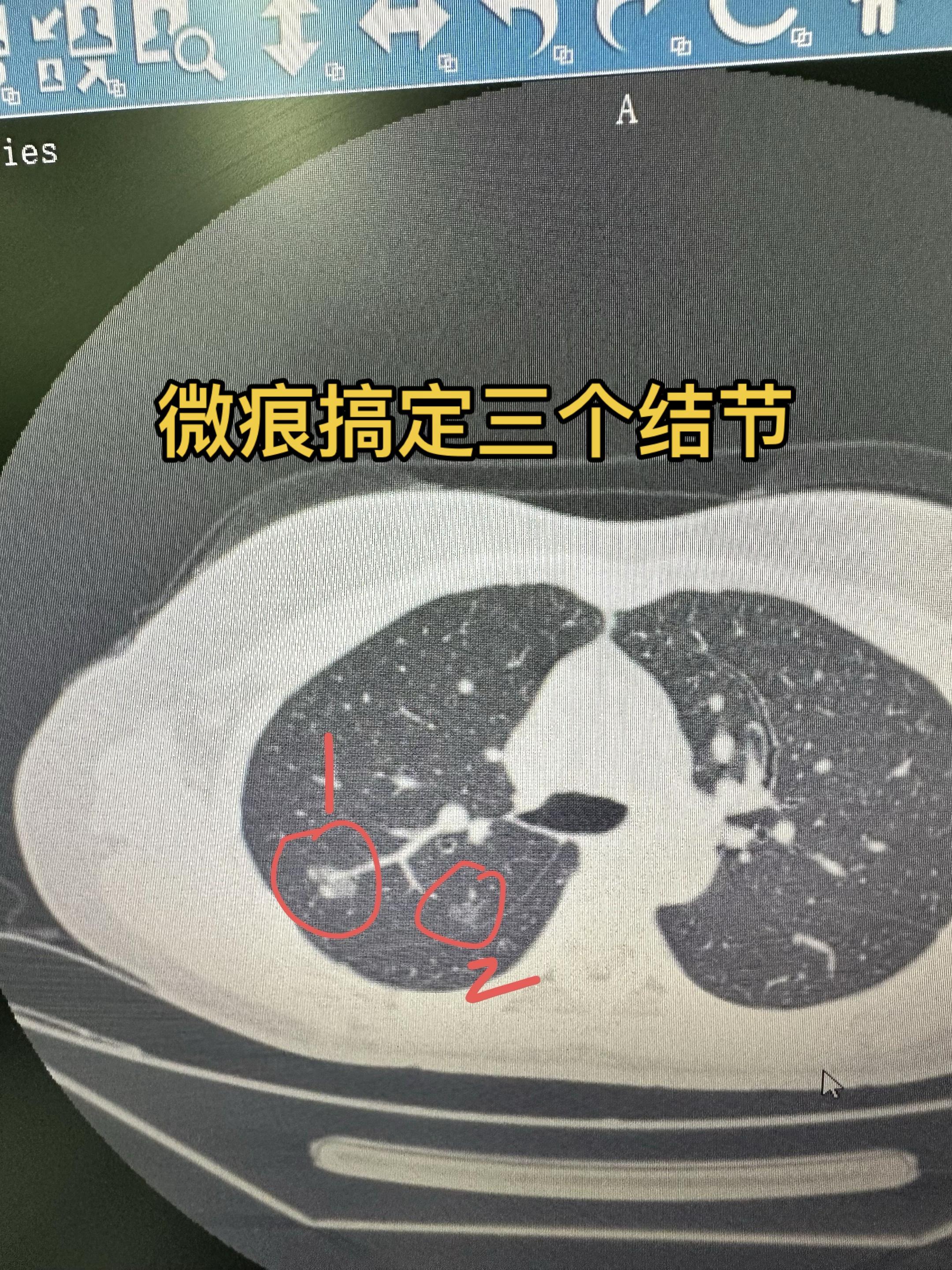 微痕搞定三个结节。