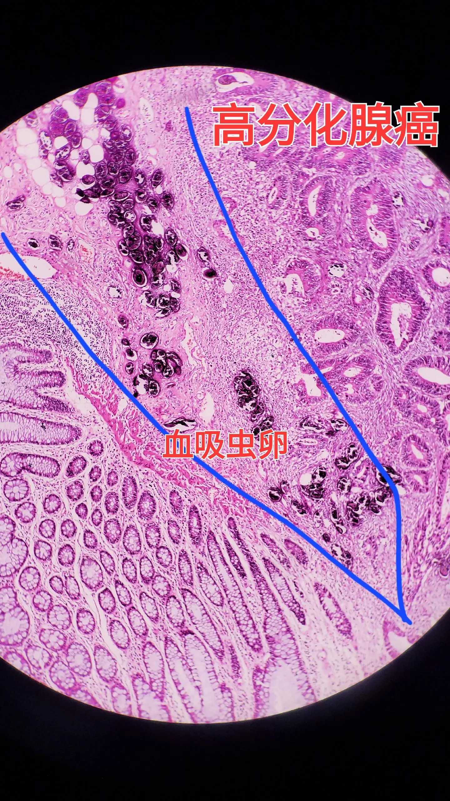血吸虫病