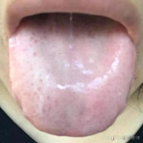 公益看舌象，挑战年前看666个舌象，你发我看，结果马上出！！！

4种常见肾虚舌