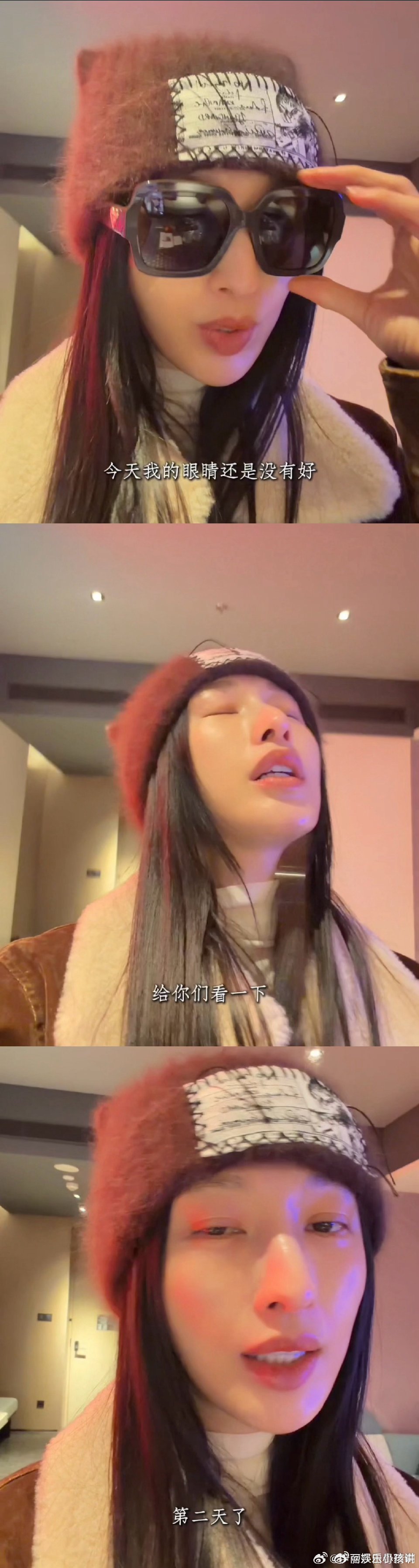 张俪眼睛毛细血管破裂张俪眼睛毛细血管破裂仍坚持工作，看着让人格外心疼，敬业态度让