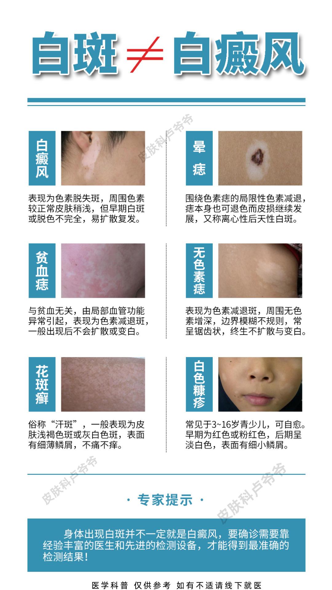 别搞错了，白斑不一定是白癜风