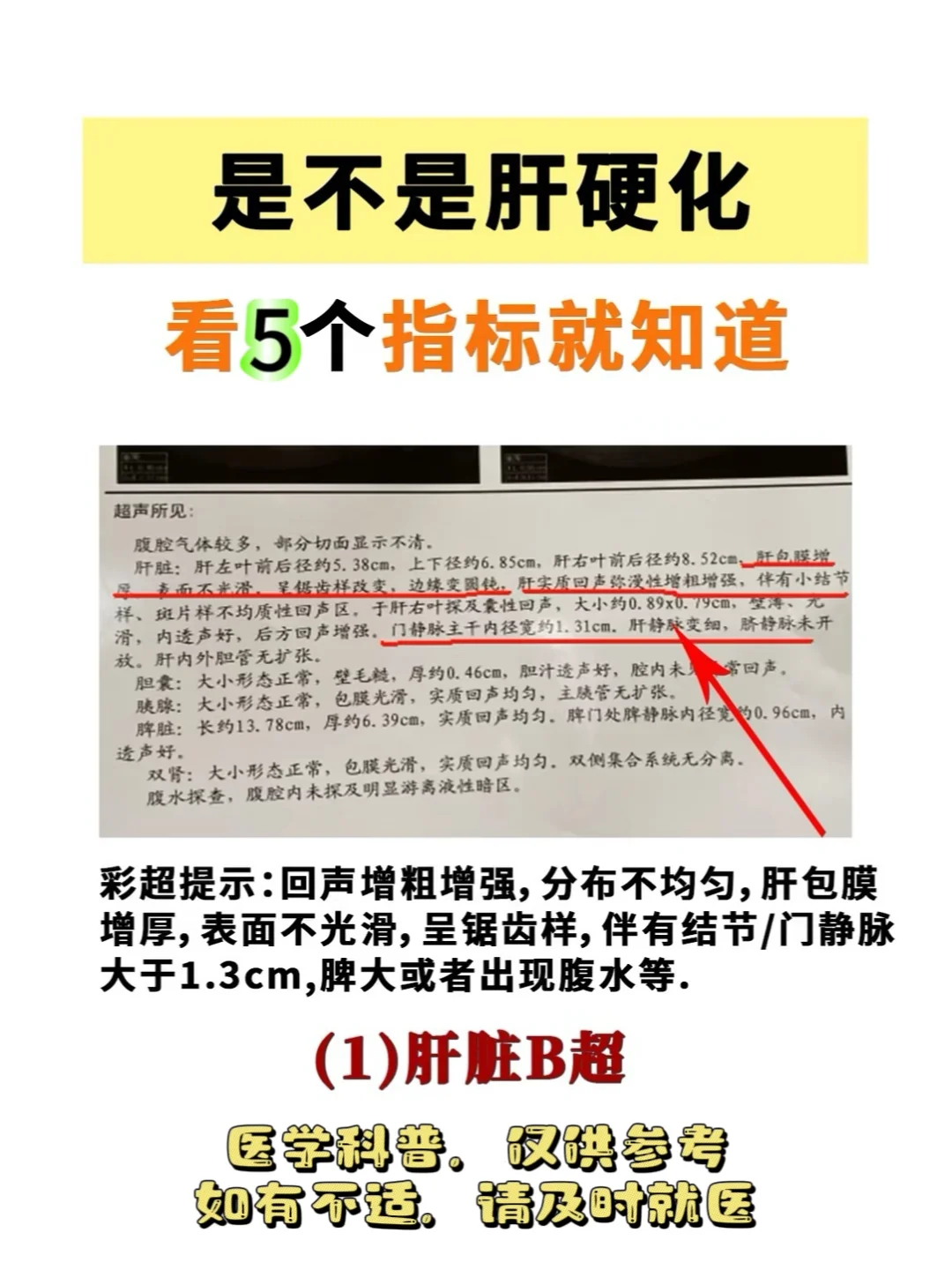 是不是肝硬化，看5个指标就知道 