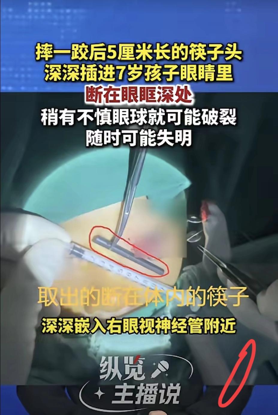 一根筷子差点毁了孩子一生，家长别再心存侥幸
 
孩子拿着筷子玩耍摔倒，一截断筷直