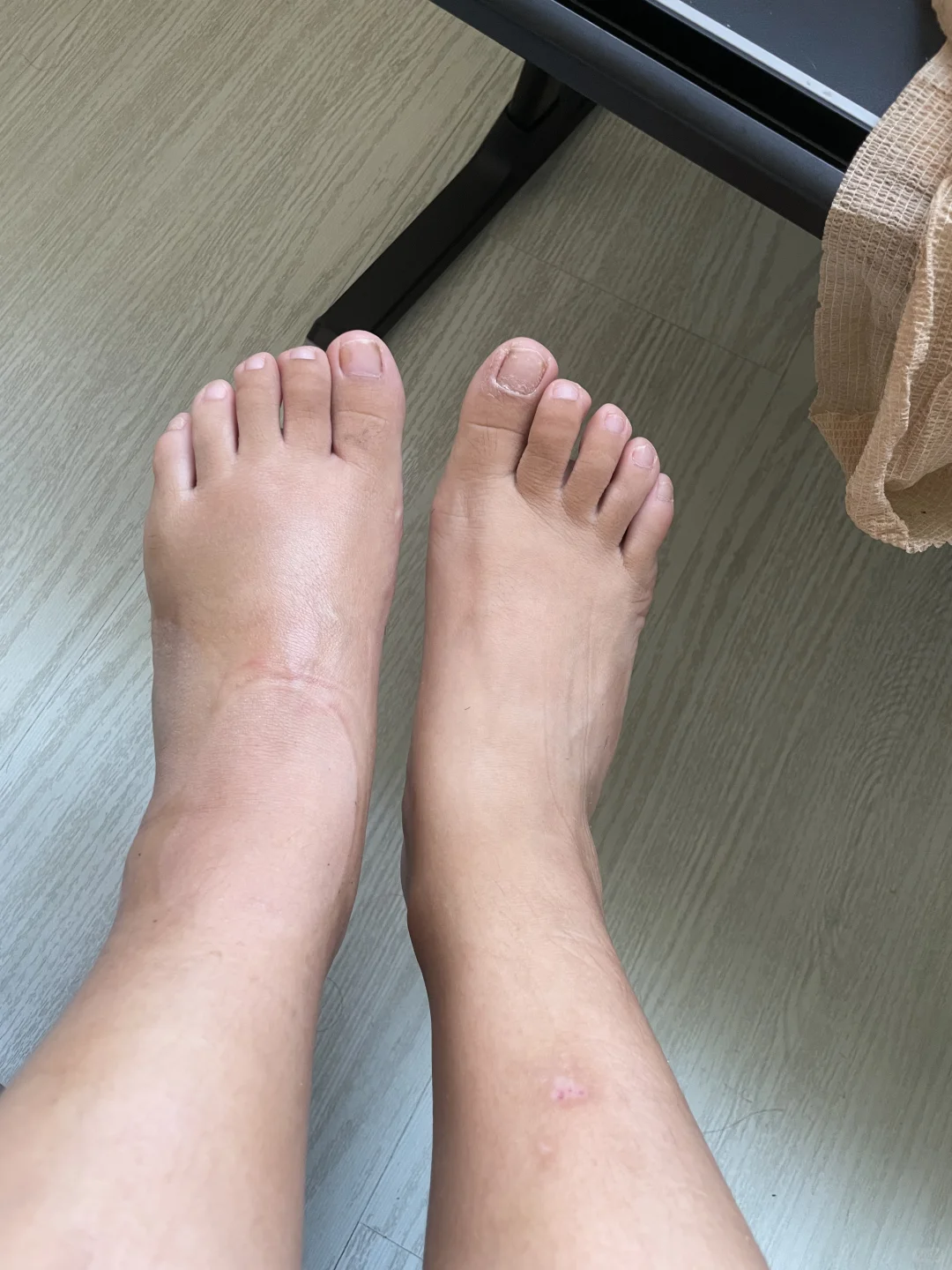 崴脚骨折中药快速修复方法