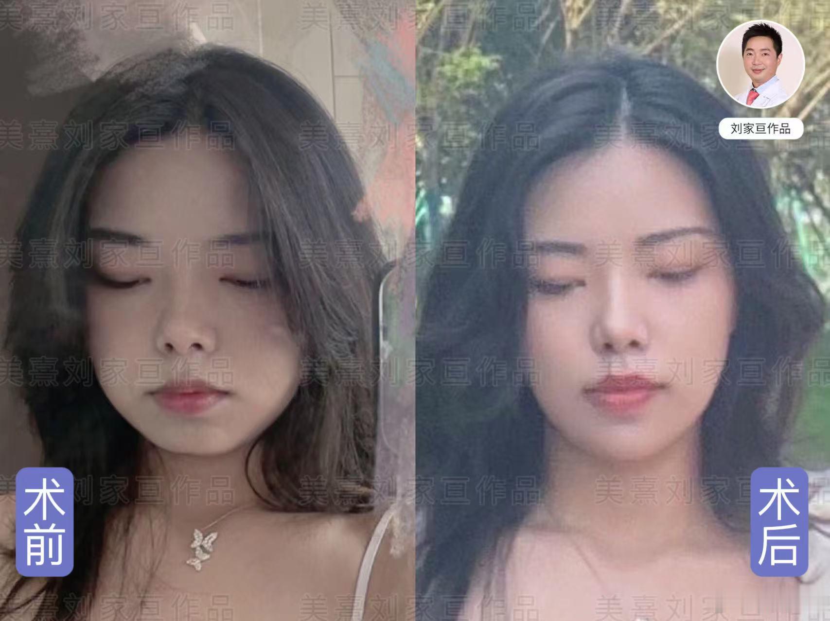 假体垫下巴，颜值气质一下拉高一个档次