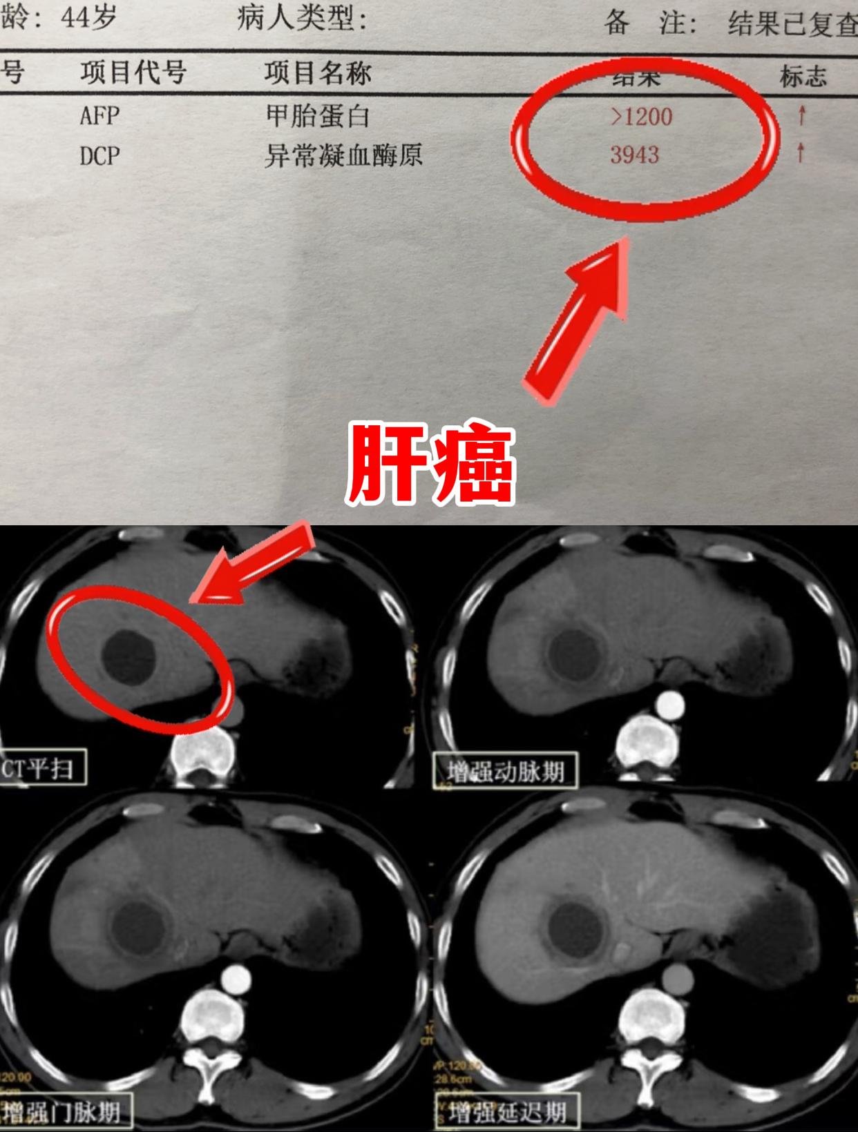 山东德州的男子，才44岁就确诊肝癌了！ 他早就知道自己有乙肝，却从没当...