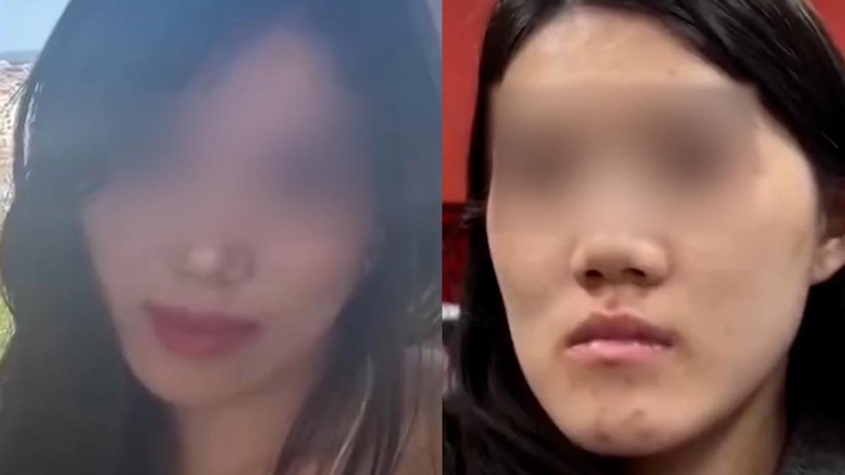好好的颌面矫正，硬生生做成毁容手术！24岁女孩正颌手术被彻底做反，造成严重颌面错