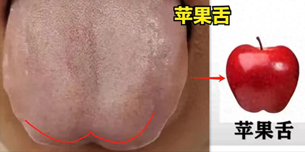 “苹果舌”、“布袋舌”、“勺子舌”三个典型的舌象分析

1. 苹果舌
舌象：舌尖