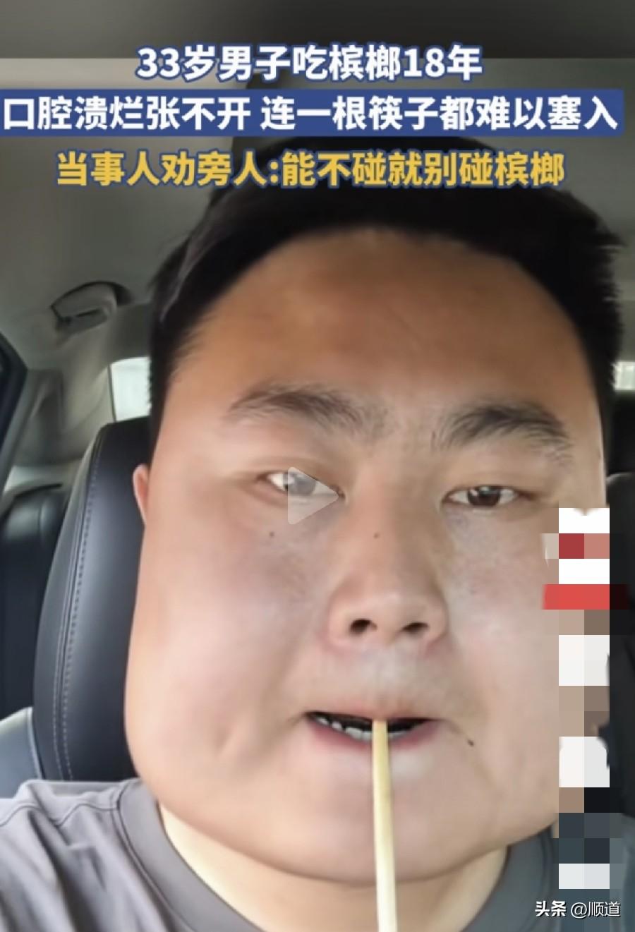 真不明白嚼槟榔还上瘾是咋回事儿，男子嚼槟榔18年，口腔溃烂，嘴张不开，连一根筷子