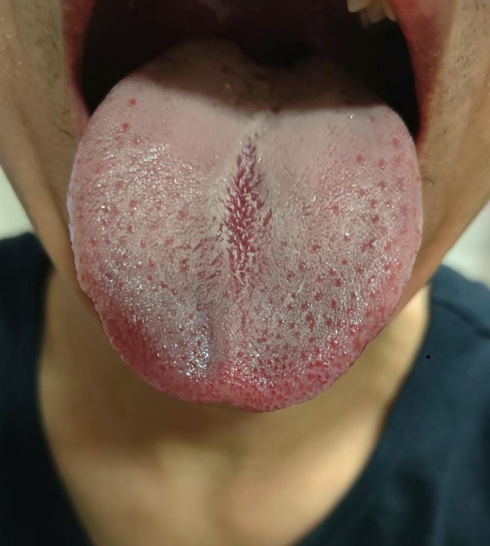 像这男人脾气不好，容易着急，失眠严重
碰到这个舌头，不单单是心肝火旺了[震惊]

